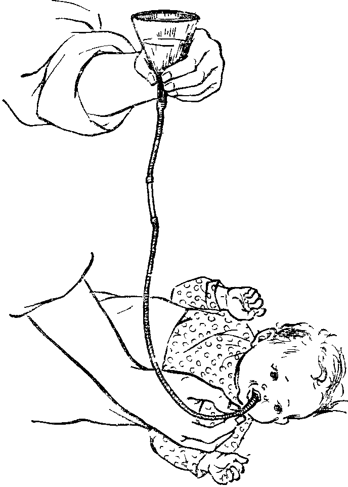 кормление ребёнка через зонд рисунок